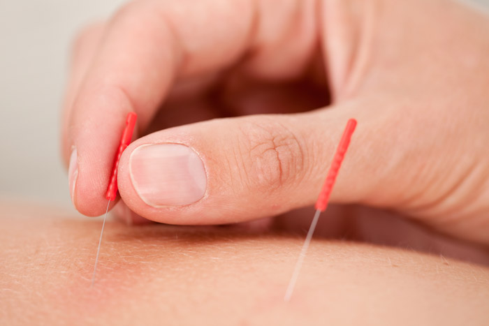acupunctuur